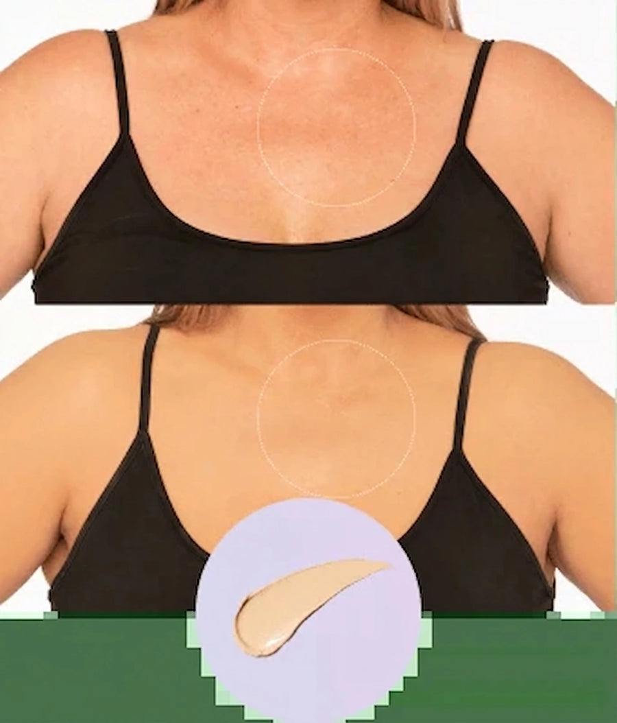Vitiligo
